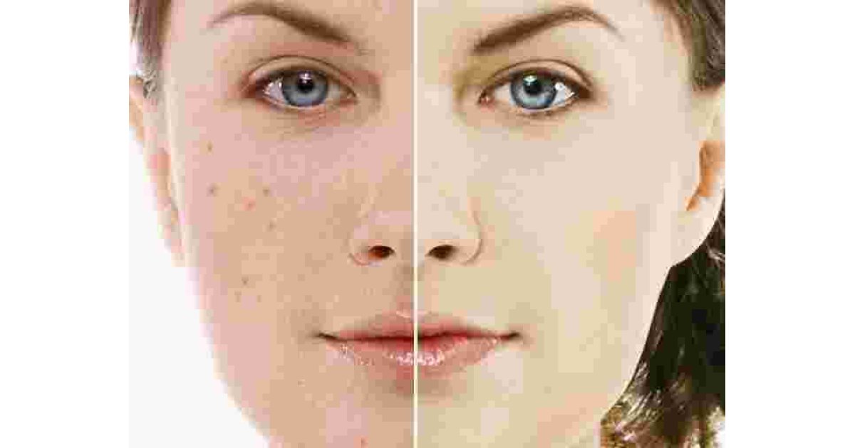 Acne Meaning and Definition