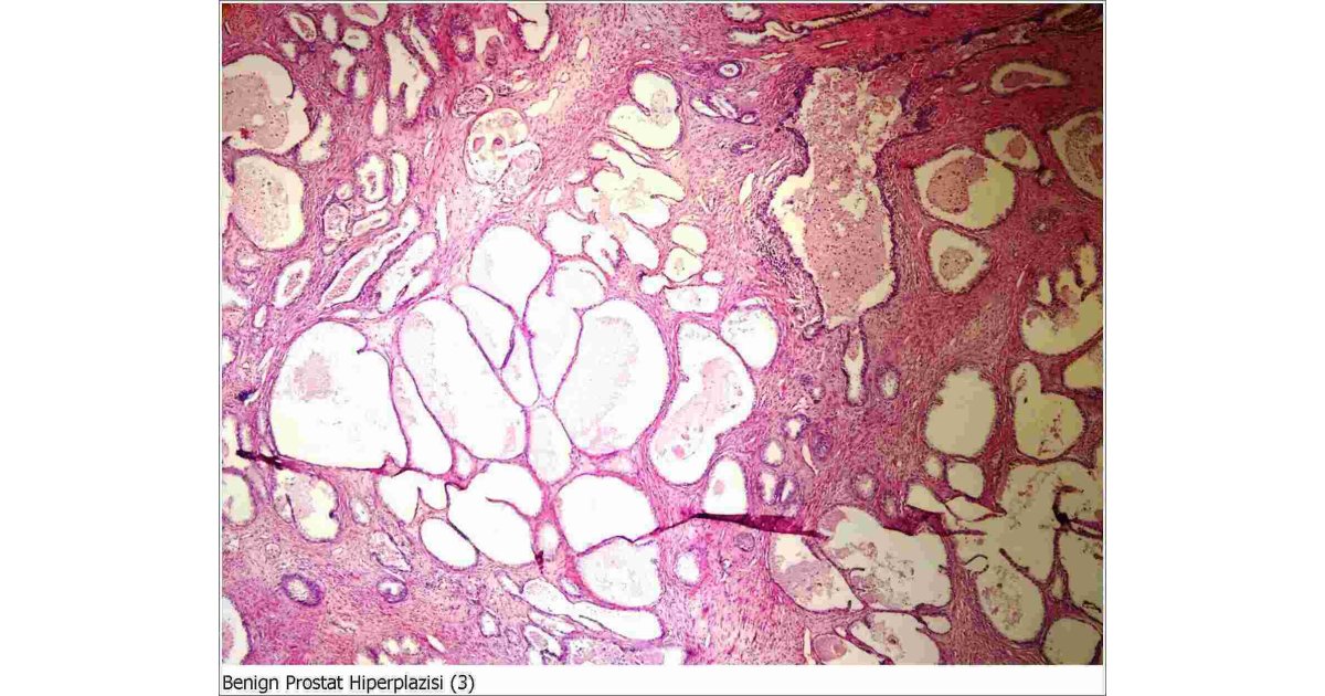 Benign Meaning and Definition