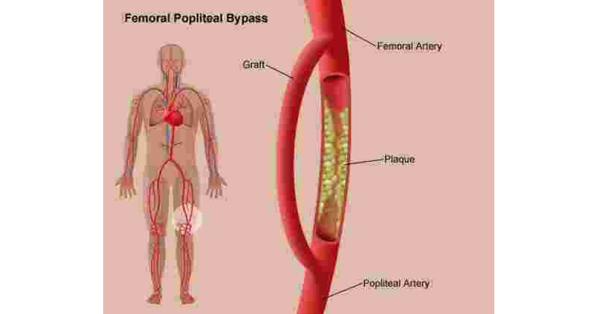 Bypass Meaning and Definition