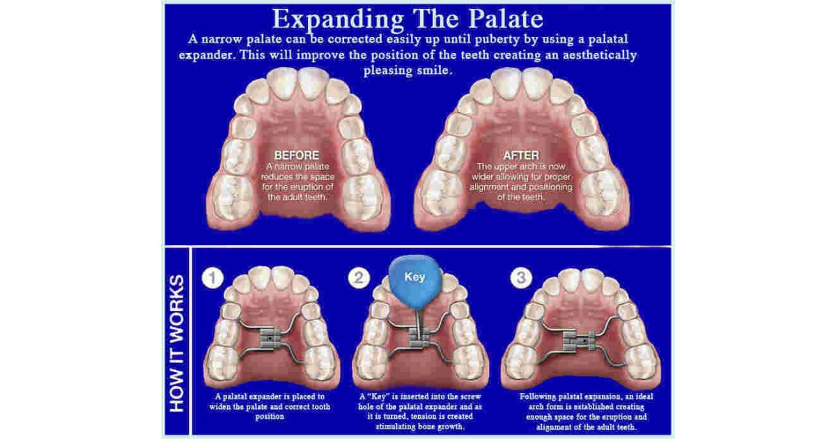 Expanding Meaning and Definition