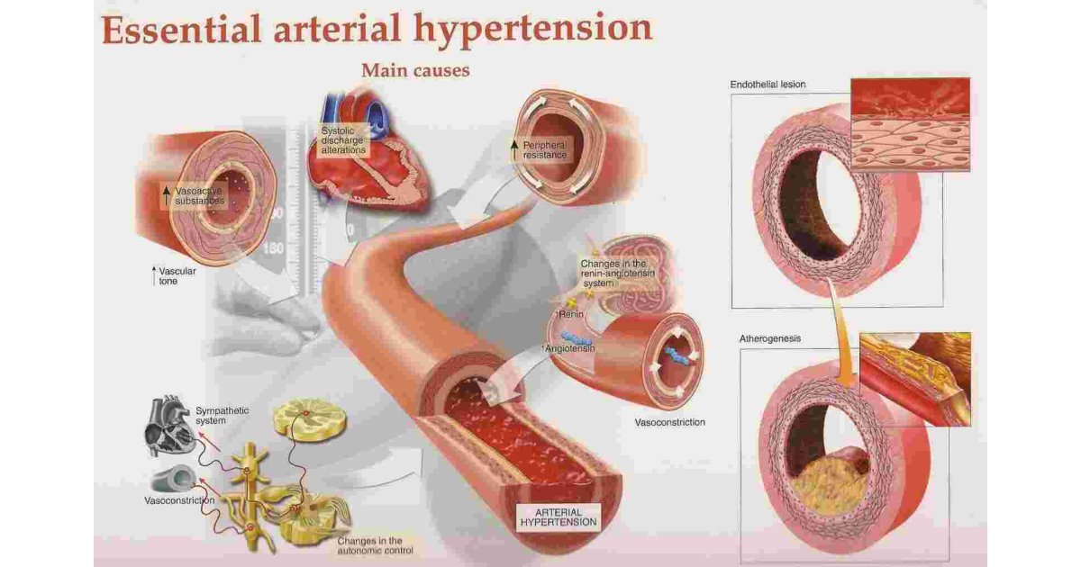 Hypertension Meaning and Definition