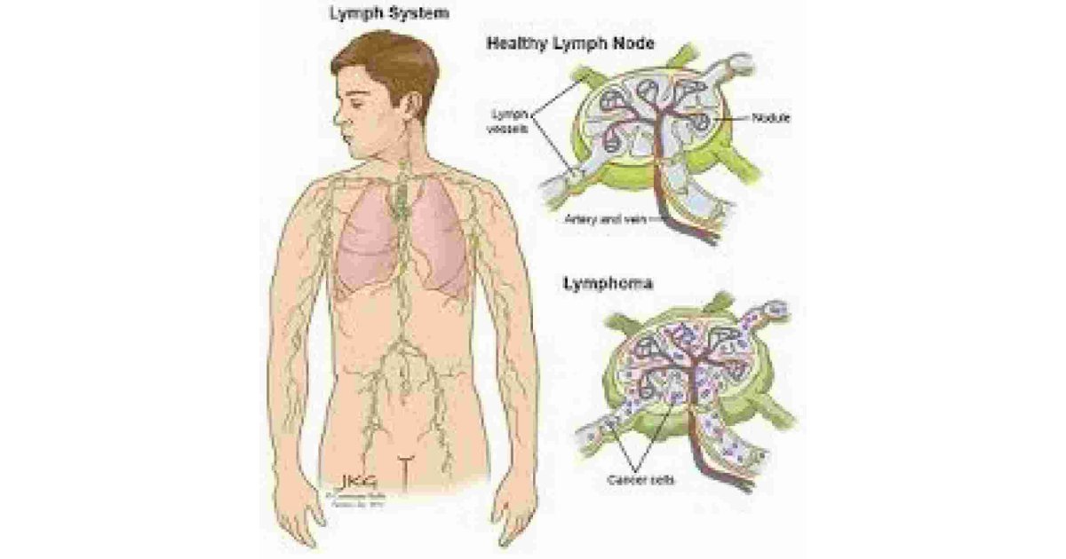 Lymphoma Meaning and Definition