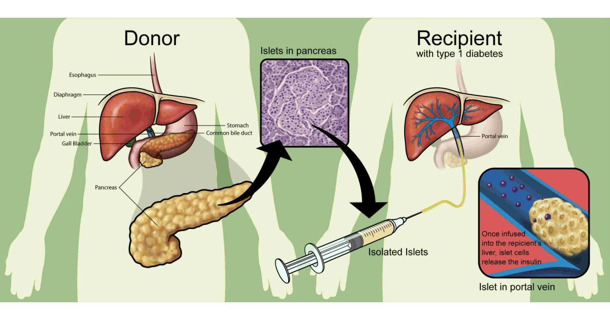 Transplantation Meaning and Definition