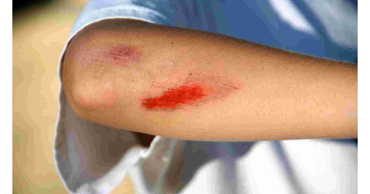 Wound Meaning and Definition