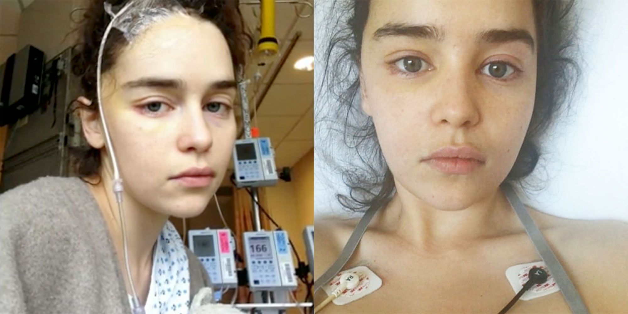 Emilia Clarke after brain surgery: It's a miracle I've been able to get on with my life