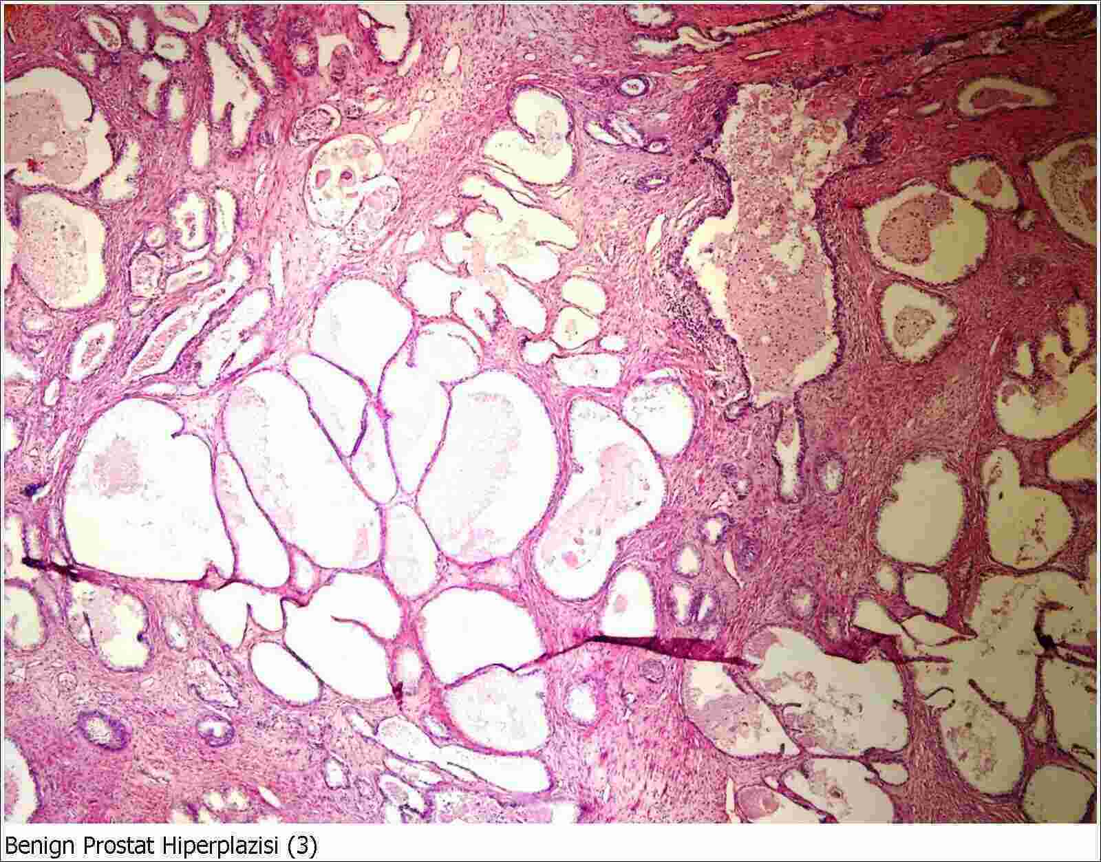 Benign Meaning and Definition