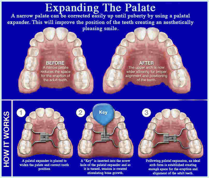 Expanding Meaning and Definition