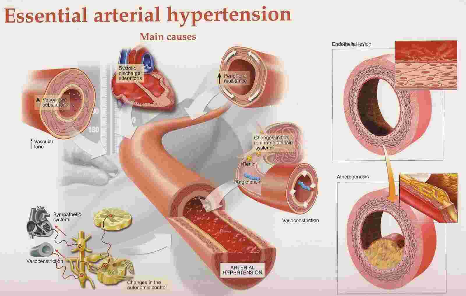 Hypertension Meaning and Definition