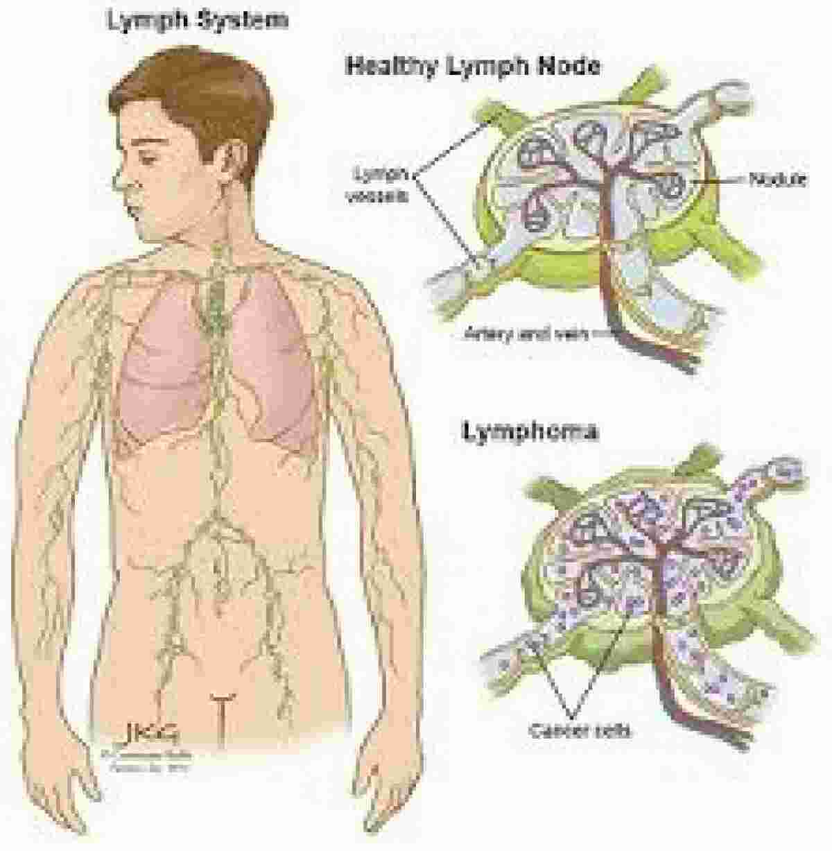 Lymphoma Meaning and Definition