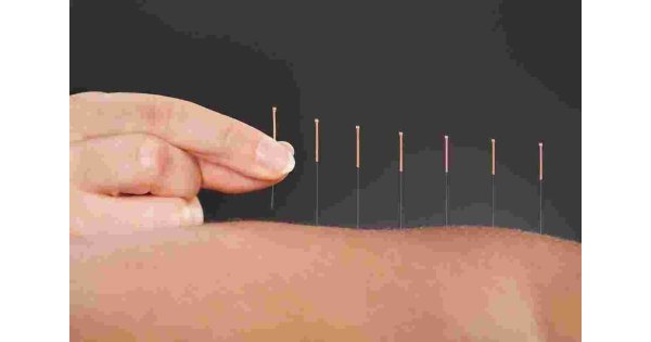 Acupuncture Meaning and Definition