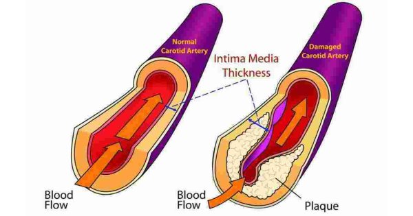 Artery Meaning and Definition
