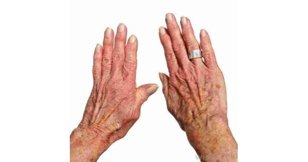 Arthritis Meaning and Definition