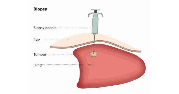 Biopsy Meaning and Definition