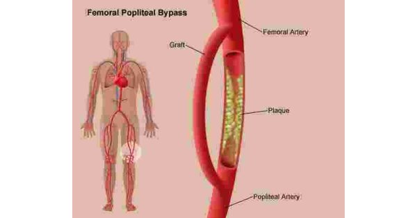 Bypass Meaning and Definition Bypass Meaning and Definition