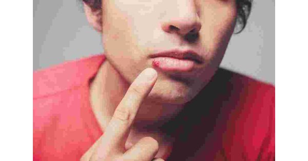 Herpes Meaning and Definition