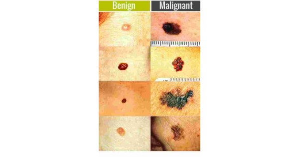 Malignant Meaning and Definition