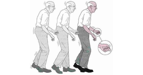 Parkinson Meaning and Definition
