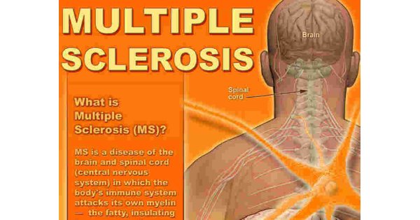 Sclerosis Meaning and Definition