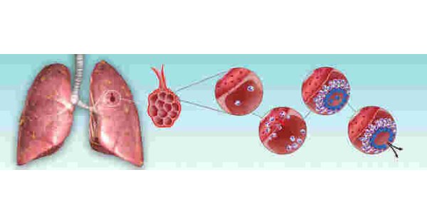 Tuberculosis Meaning and Definition