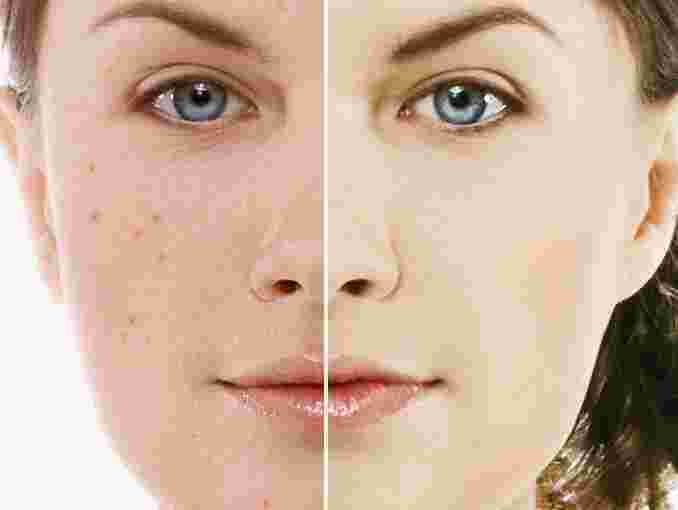 Acne Meaning and Definition