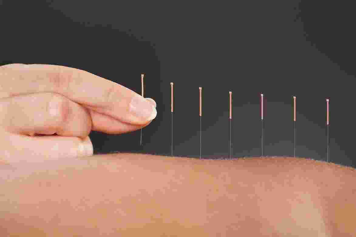 Acupuncture Meaning and Definition