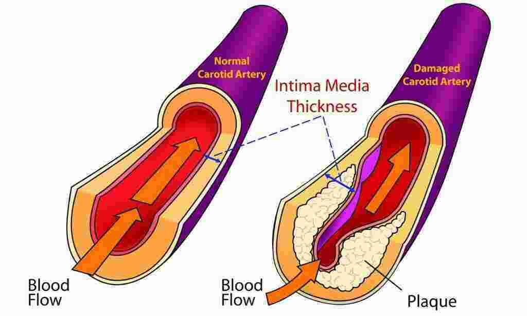 Artery Meaning and Definition