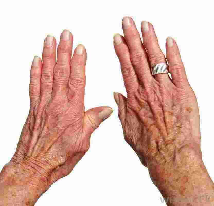Arthritis Meaning and Definition