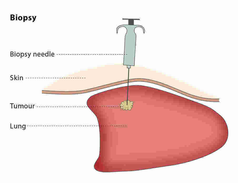 Biopsy Meaning and Definition