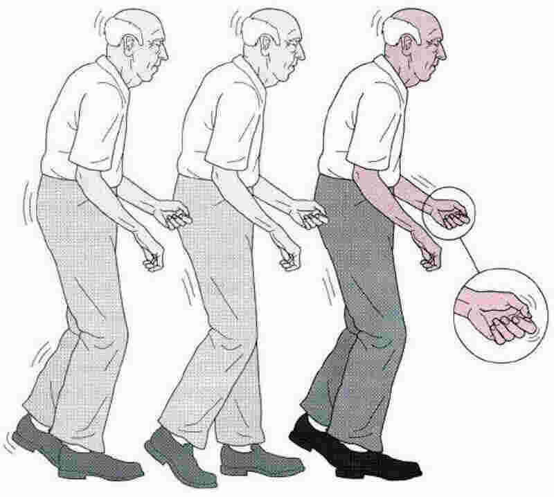 Parkinson Meaning and Definition