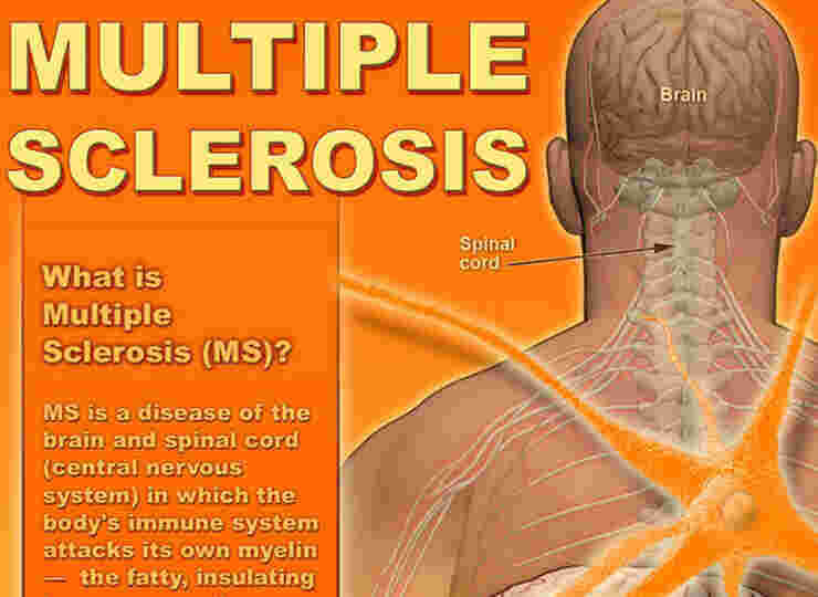 Sclerosis Meaning and Definition