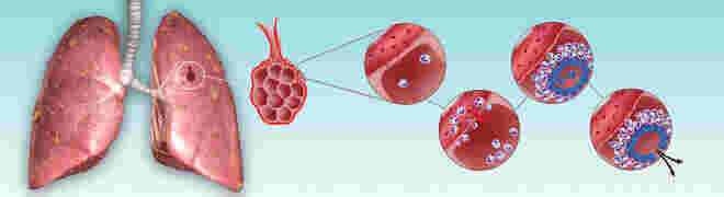 Tuberculosis Meaning and Definition