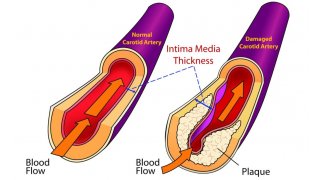 Artery Meaning and Definition