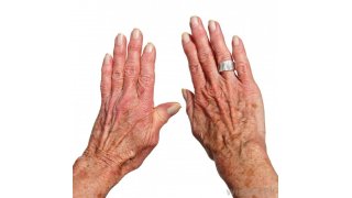 Arthritis Meaning and Definition