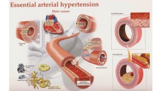 Hypertension Meaning and Definition