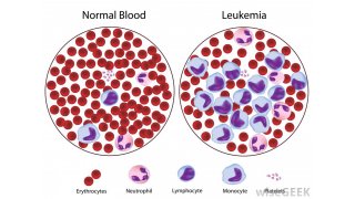 Leukemia Meaning and Definition