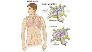 Lymphoma Meaning and Definition
