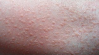 Rash Meaning and Definition