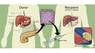 Transplantation Meaning and Definition