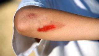 Wound Meaning and Definition