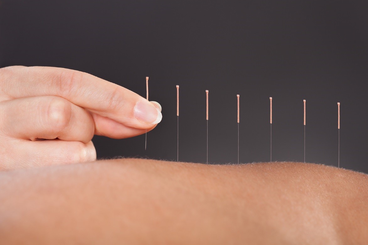 Acupuncture Meaning and Definition