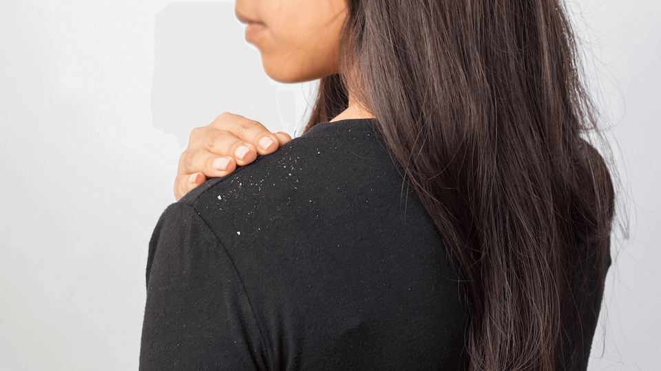 What causes dandruff in the hair? How does dandruff go away? What is good against dandruff?